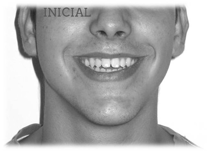 Antes
